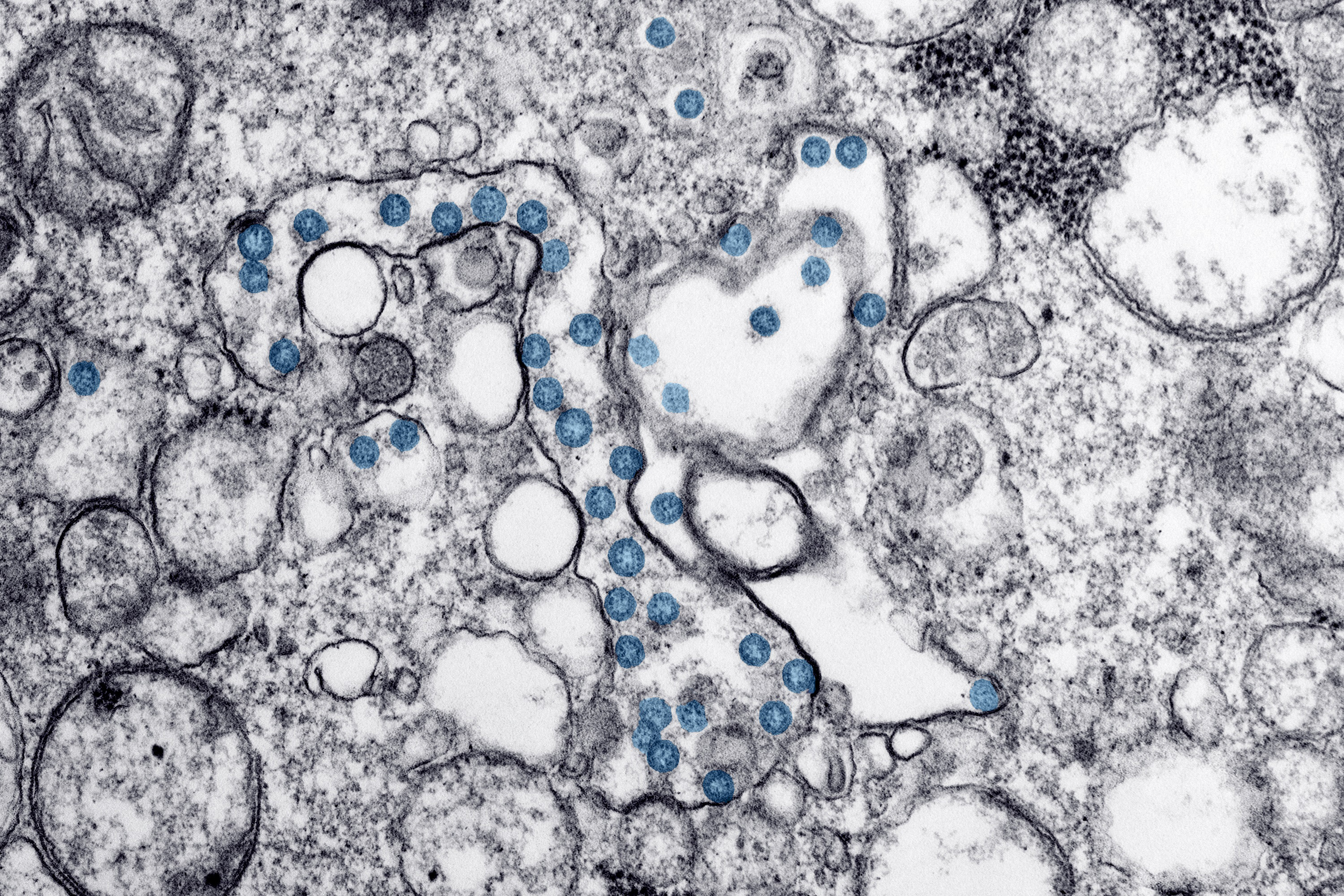 Transmission electron microscopic image from the first U.S. case of COVID-19. The spherical viral particles, colorized blue, contain cross-section through the viral genome, seen as black dots. (Credit: Centers for Disease Control and Prevention)